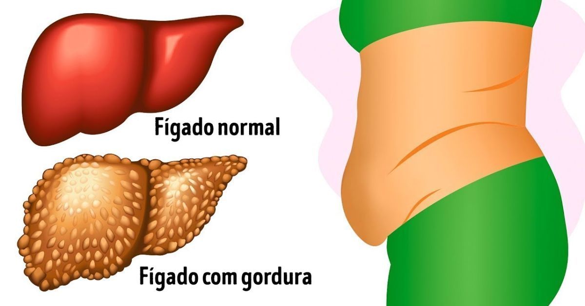 Esse sÃ£o os primeiros sintomas que o corpo dÃ¡ quando vocÃª tem gordura no fÃ­gado, esteja atento