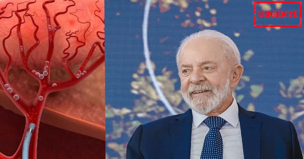 O que Ã© embolizaÃ§Ã£o das artÃ©rias menÃ­ngeas: Entenda por que o presidente Lula terÃ¡ que ser submetido novo procedimento cirÃºrgico